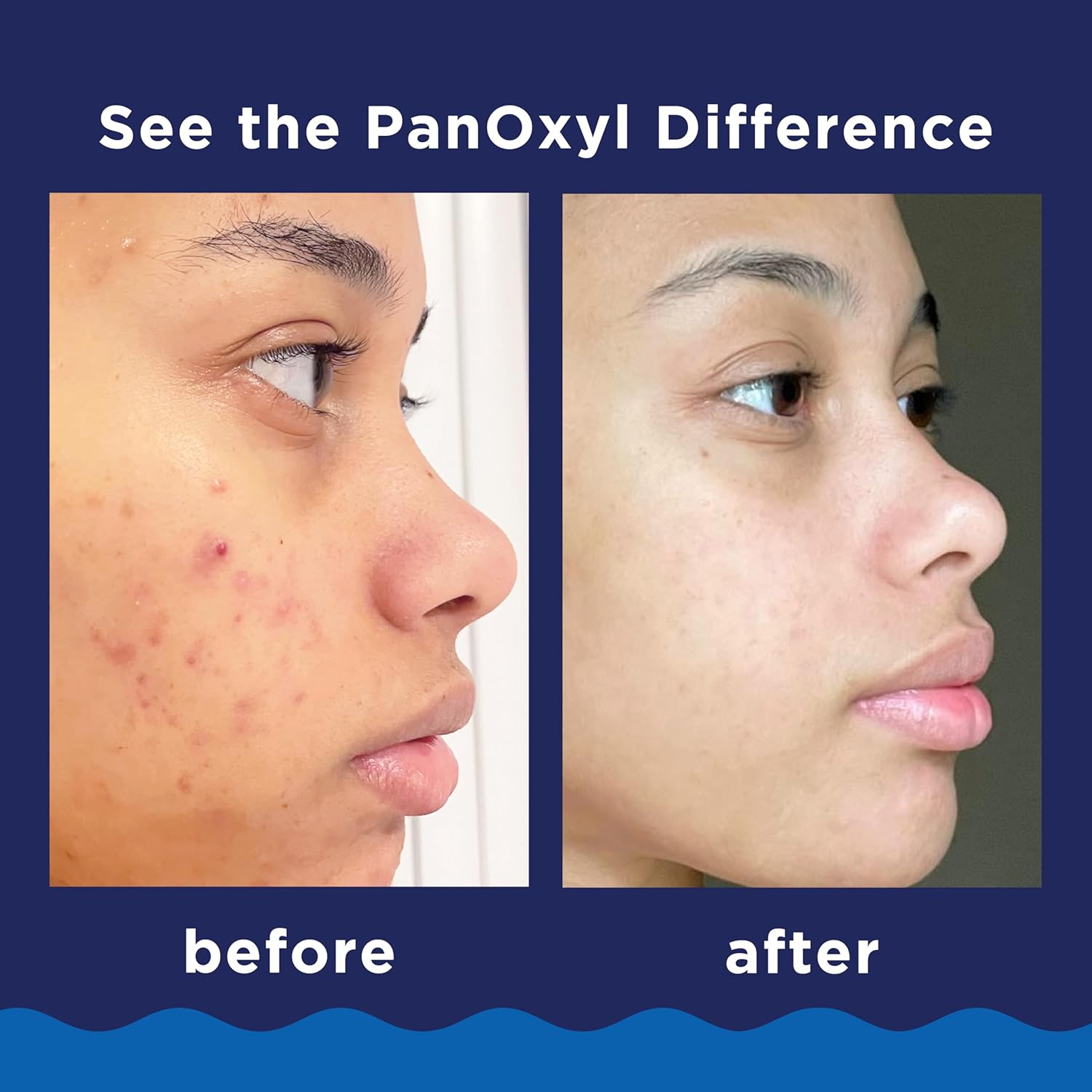 PanOxyl Benzoyl Peroxide Wash